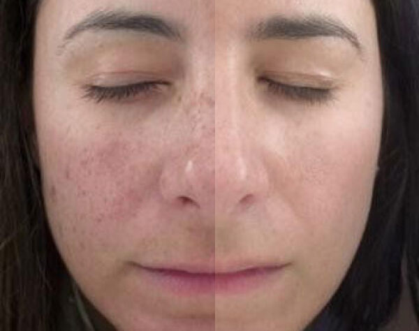 before and after an IPL photofacial