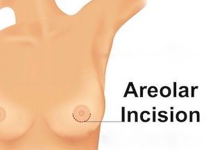areolar incision infographic