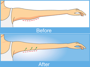 Recovering from Plastic Surgery: Arm Lift Recovery