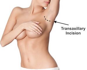 transaxillary incision infographic showing incision location