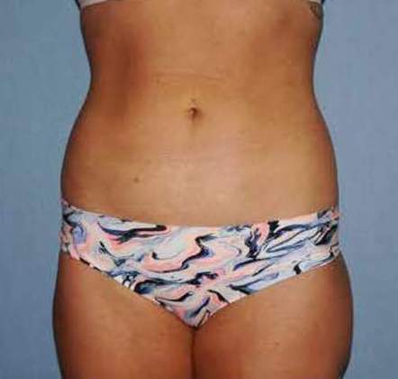 Liposuction Before And After Patient 19