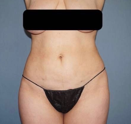 Liposuction Before And After Patient 21