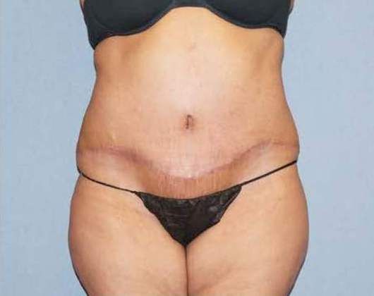 Abdominoplasty & Liposuction of Posterior Hips Before And After Patient 34