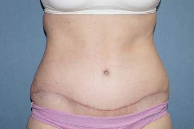 Abdominoplasty & Liposuction of Posterior Hips Before And After Patient 35