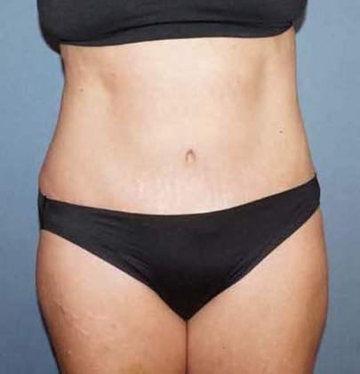 Abdominoplasty & Liposuction of Posterior Hips Before And After Patient 36