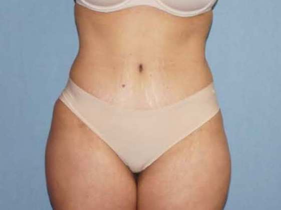 Abdominoplasty & Liposuction of Posterior Hips Before And After Patient 37