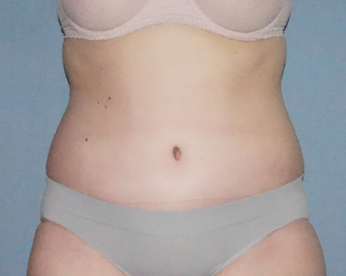 Abdominoplasty & Liposuction of Posterior Hips Before And After Patient 38