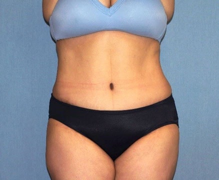 Abdominoplasty & Liposuction of Posterior Hips Before And After Patient 43