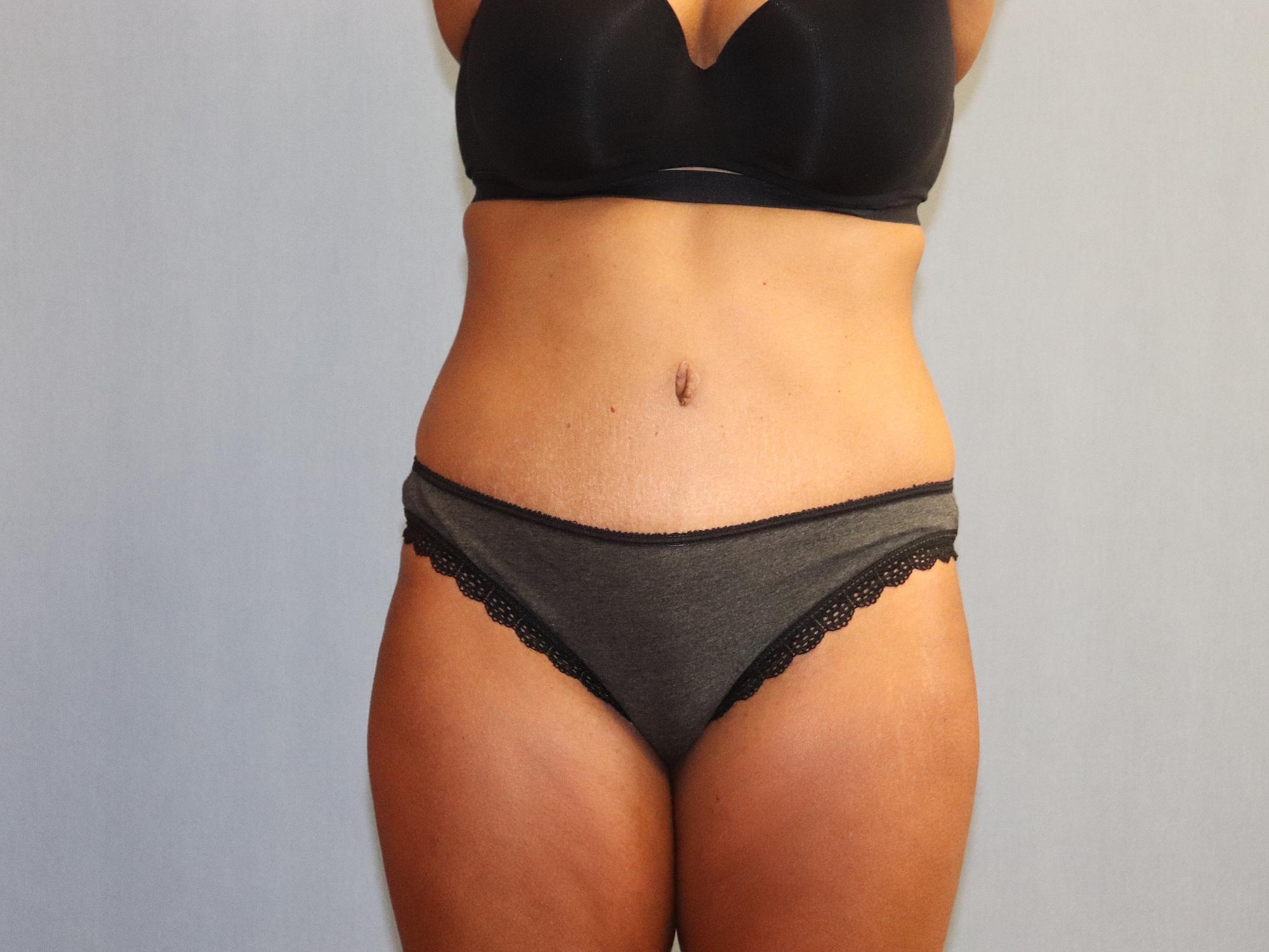 Abdominoplasty & Liposuction of Posterior Hips Before And After Patient 46