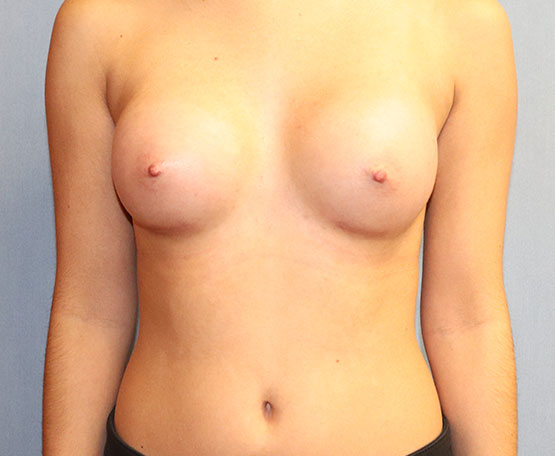 Breast Augmentation Before And After Patient 56