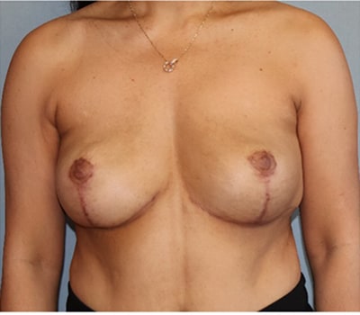 Breast Augmentation with Lift Before And After Patient 1