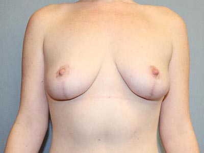 Breast Lift Before And After Patient 12