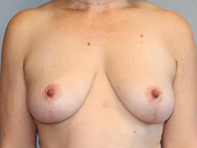 Breast Lift Before And After Patient 13