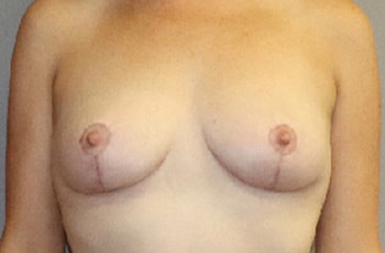 Breast Lift Before And After Patient 20