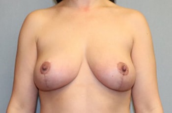 Breast Lift Before And After Patient 21