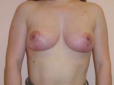Breast Lift Before And After Patient 25