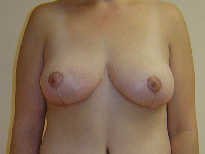 Breast Lift Before And After Patient 27