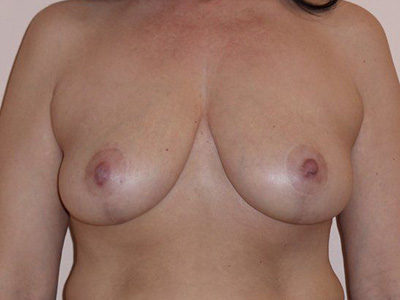 Breast Lift Before And After Patient 28