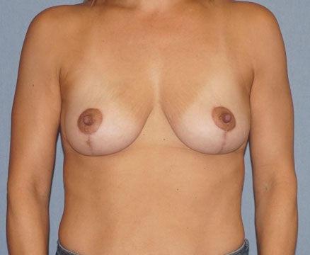 Breast Lift Before And After Patient 31