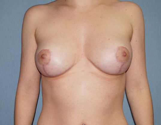 Breast Reduction Before And After Patient 8