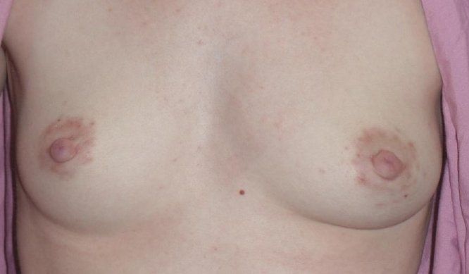Inverted Nipple(s) Correction Before And After Patient 1