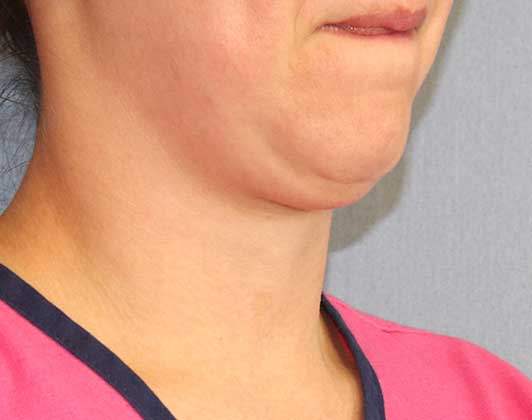 SmartLipo Neck Before And After Photo