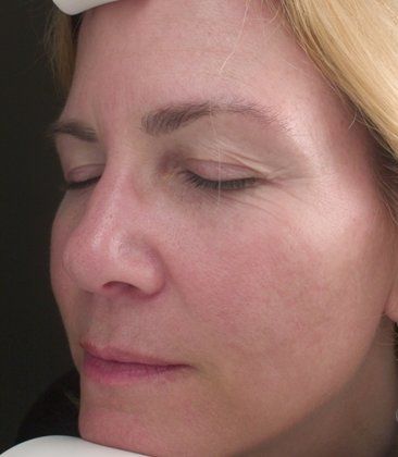 IPL Photofacial Before And After Patient 11