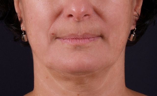 Non-Invasive Skin Tightening Before And After Patient 17