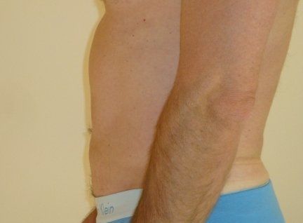 Liposuction For Men Before And After Photo