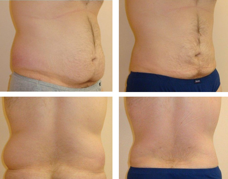 Male Patient Liposuction of Abdomen & Hips Before And After