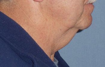 Smartlipo on male neck Before And After