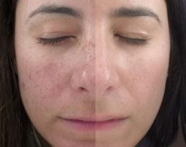 Microneedling