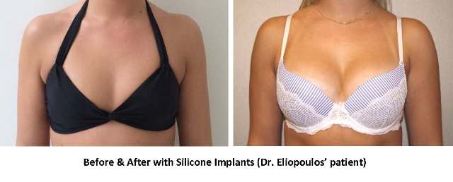 Silicone Gel Implant Before and After Photo
