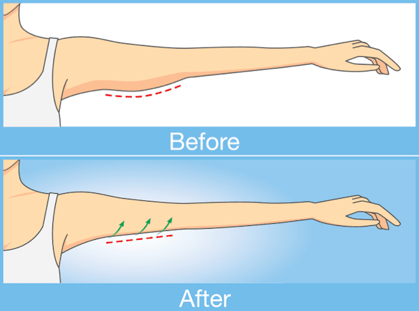 Arm Lift before and after illistration