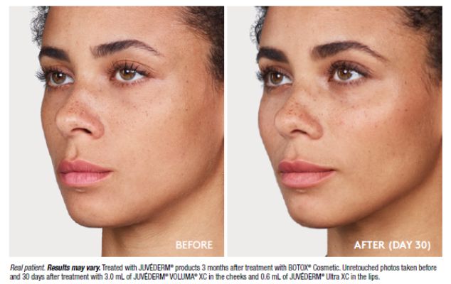 Botox Cosmetic and Juvéderm Filler before and after, courtesy of Allergan Aesthetics