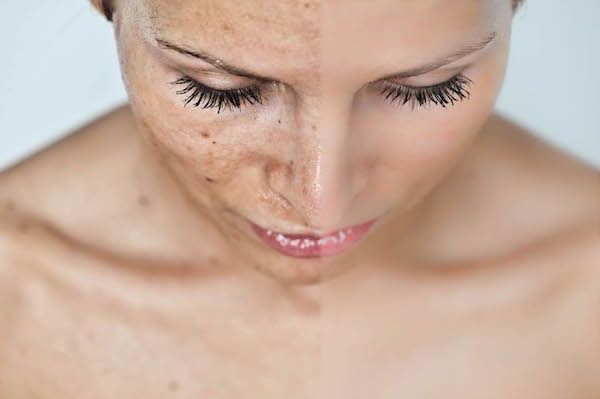 Hyperpigmentation treatments