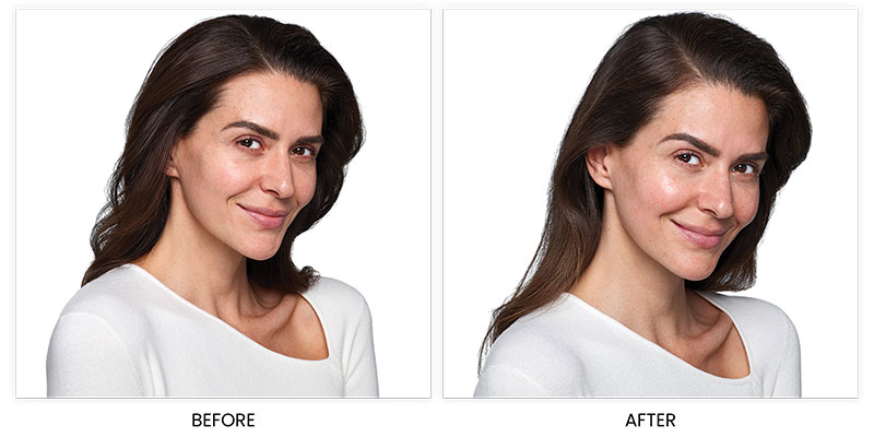 Juvéderm® SKINVIVE™ Before and After Photos Speak for the Effectiveness of this “Skin Booster”