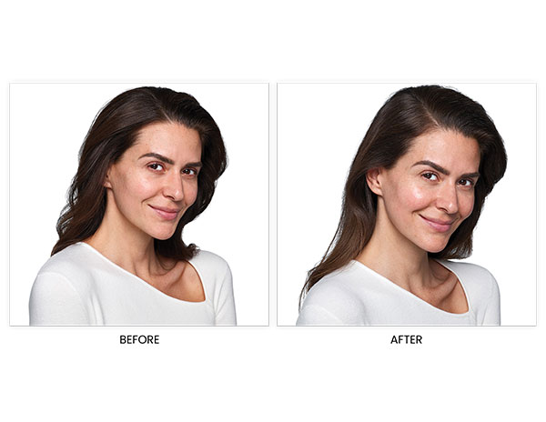 Juvéderm® SKINVIVE™ Before and After Photos Speak for the Effectiveness of this “Skin Booster”