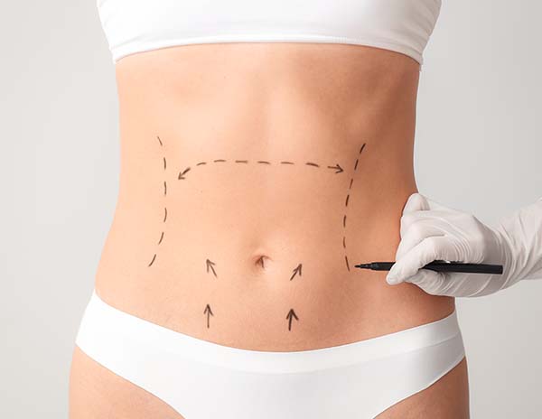 Tummy Tuck—Different Types