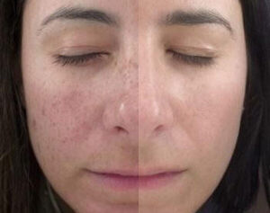 5 IPL Photofacial Benefits that My Patients Rave About