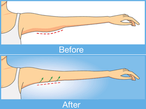 Arm lift before and after infographic