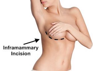 Inframammary Incision Breast Augmentation Technique
