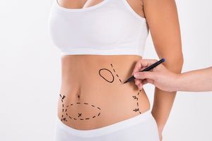 Marking a woman's waist for a tummy tuck