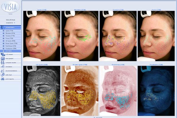 VISIA Skin Analysis