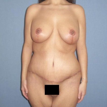 After Dramatic Weight Loss Before And After Patient 1