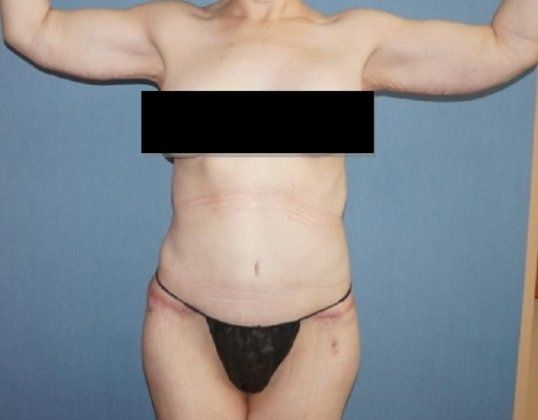 After Dramatic Weight Loss Before And After Patient 3