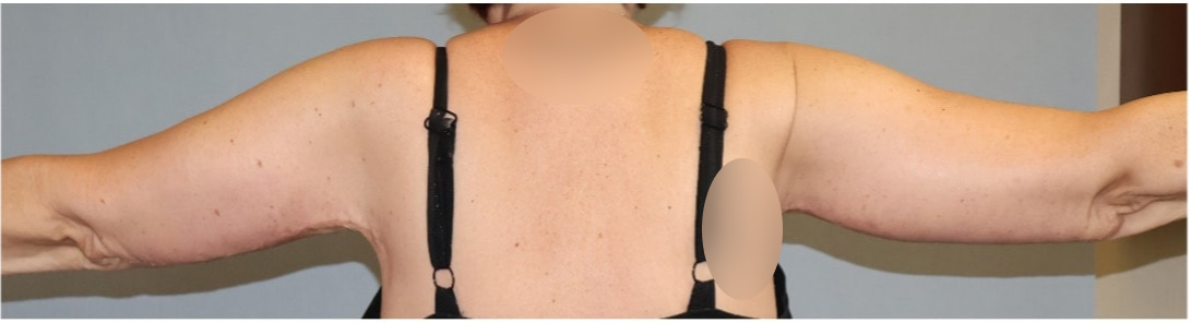 Arm Lift Before & After Image