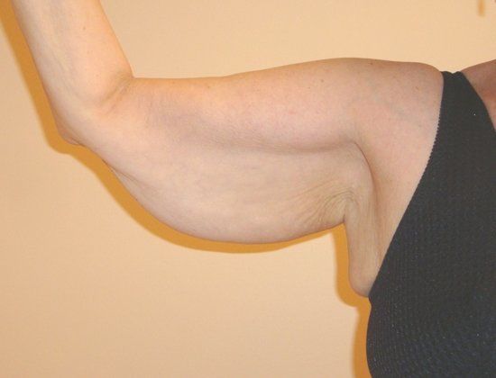 Arm Lift Before And After Photo