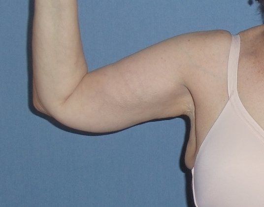 Arm Lift Before And After Photo