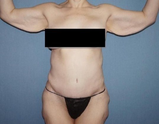 Arm Lift Before & After Image